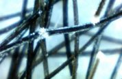 Трихоклазия узловая (trichorrhexis nodosa)